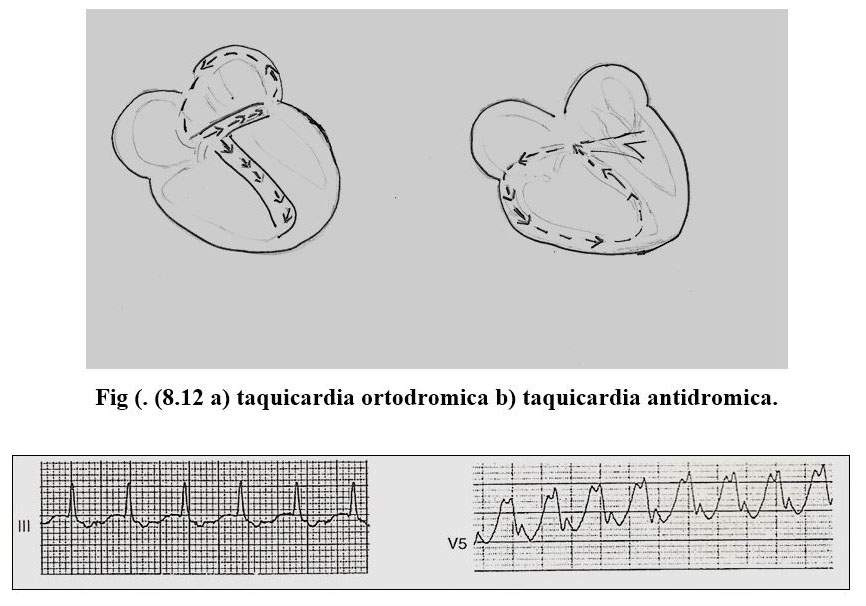 arritmia 11