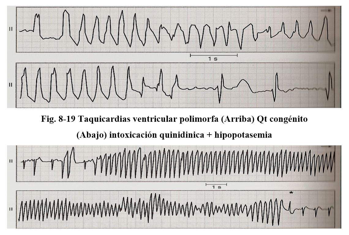 arritmia 18