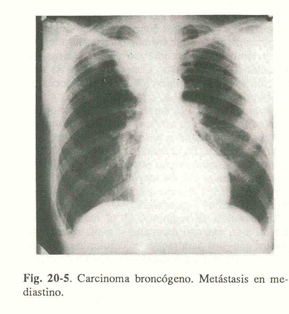 Mediastinal syndromes