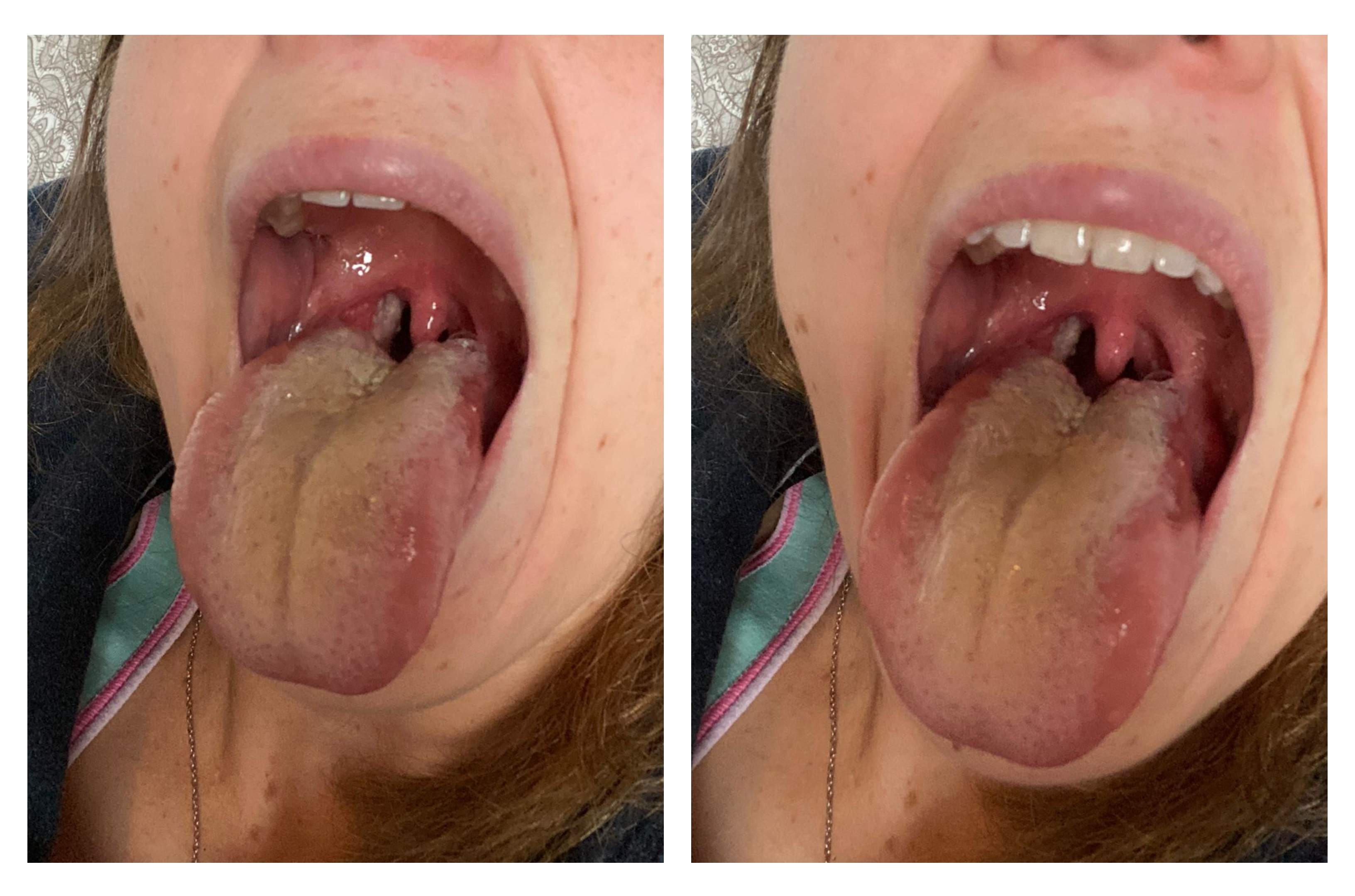 amigdalitis