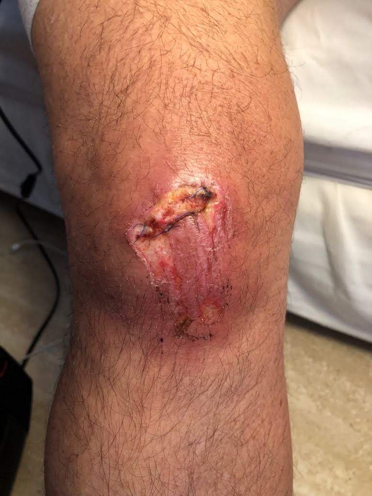 cicatrizacin03