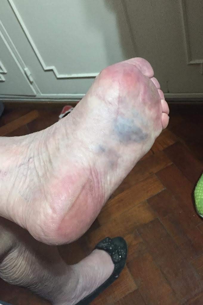 Fractura metatarsiana
