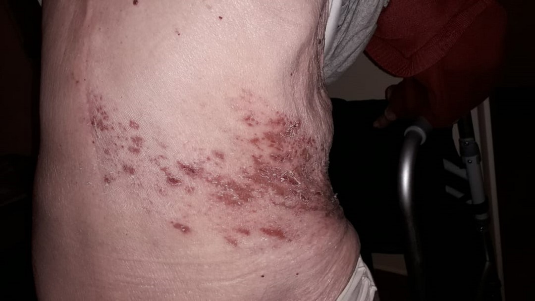 herpeszoster4