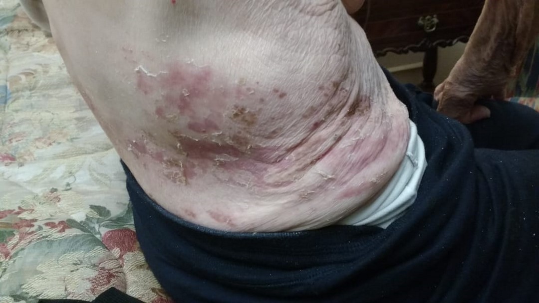 herpeszoster6
