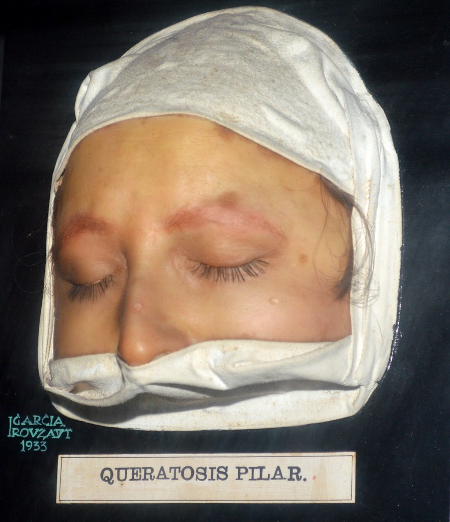 queratosis_pilar