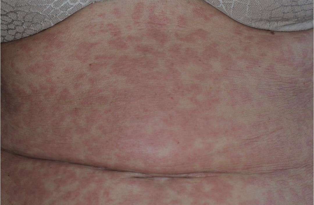 reaccioncoronavirus1