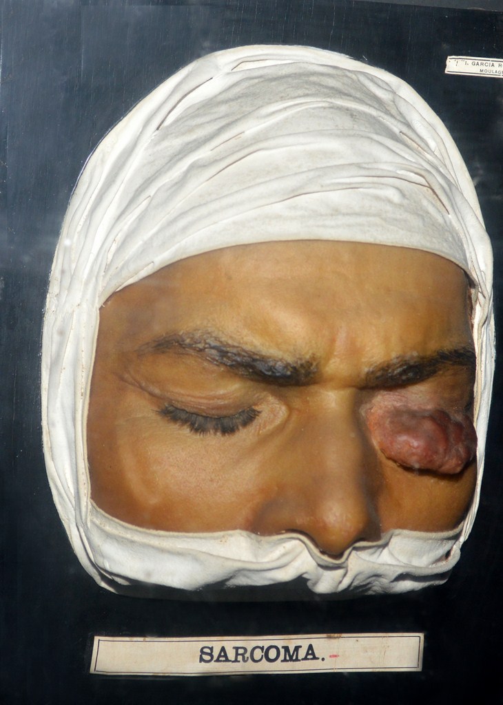 sarcoma