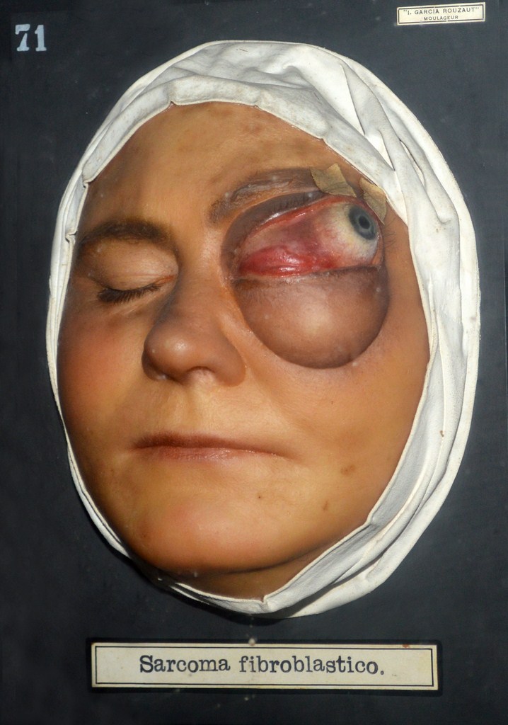 sarcoma_fibroblastico