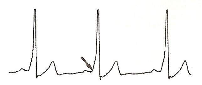 arritmia10