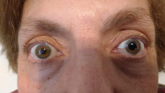 Anisocoria