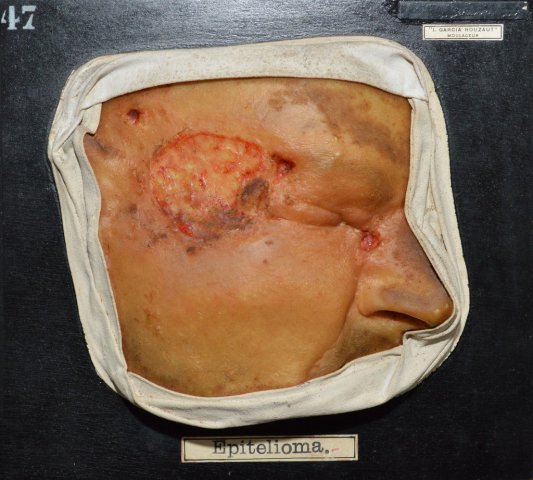 epitelioma