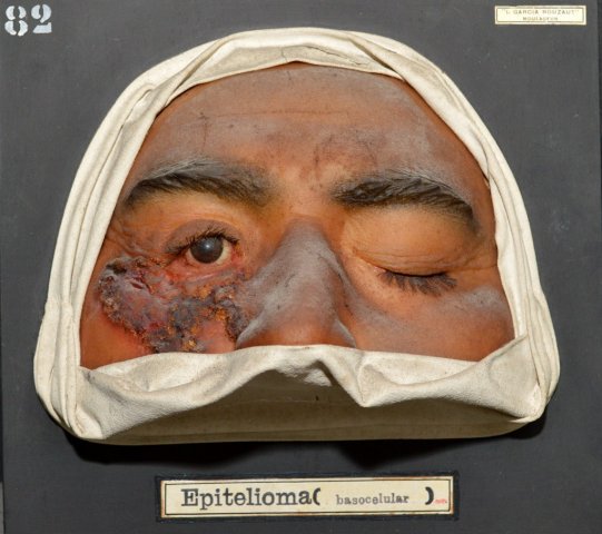 epitelioma_basocelular