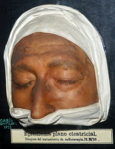 epitelioma_plano_cicatricial