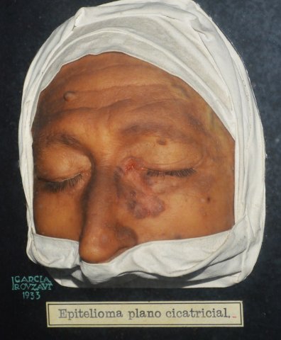 epitelioma_plano_cicatricial2