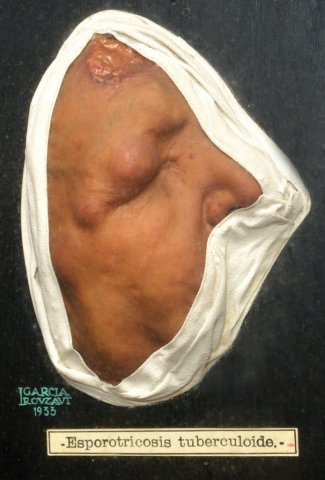 esporotricosis
