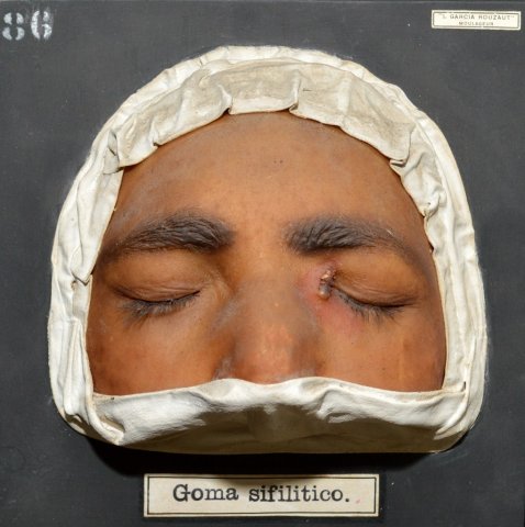 goma_sifilitico