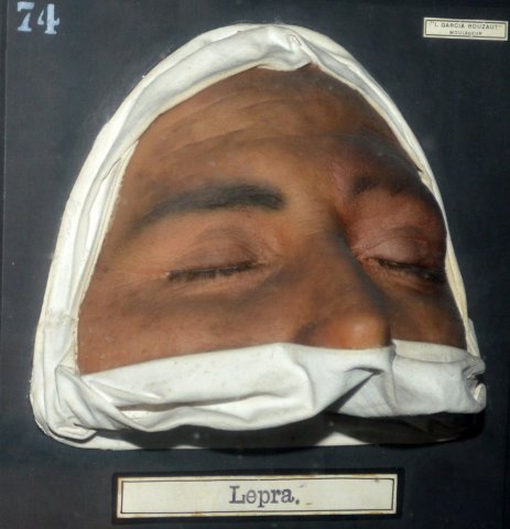 lepra