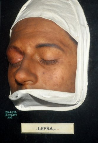 lepra2