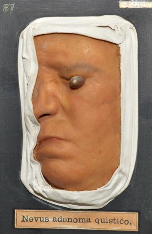 nevus_adenoma_quistico