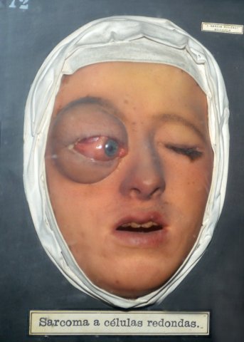 sarcoma_celulas_redondas
