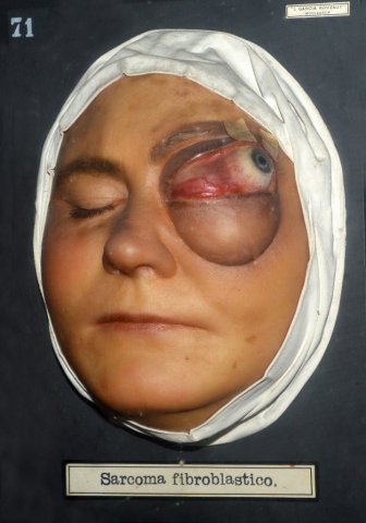 sarcoma_fibroblastico